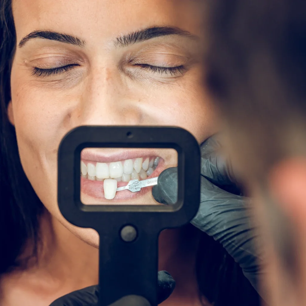 Dental veneers in rancho san diego