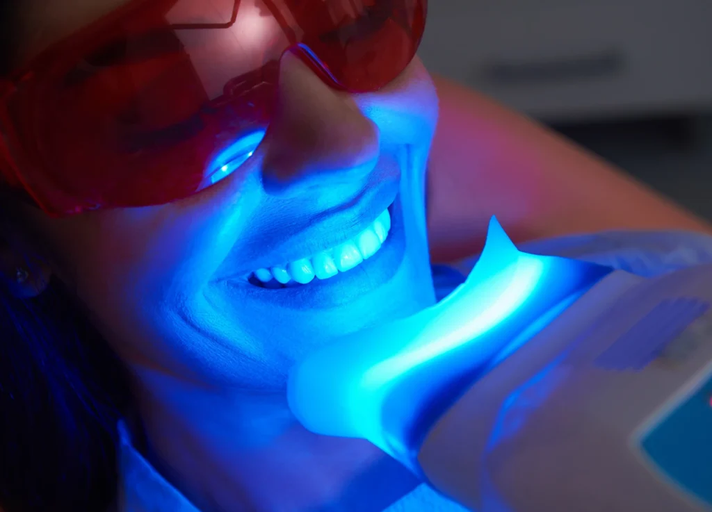 Professional Whitening