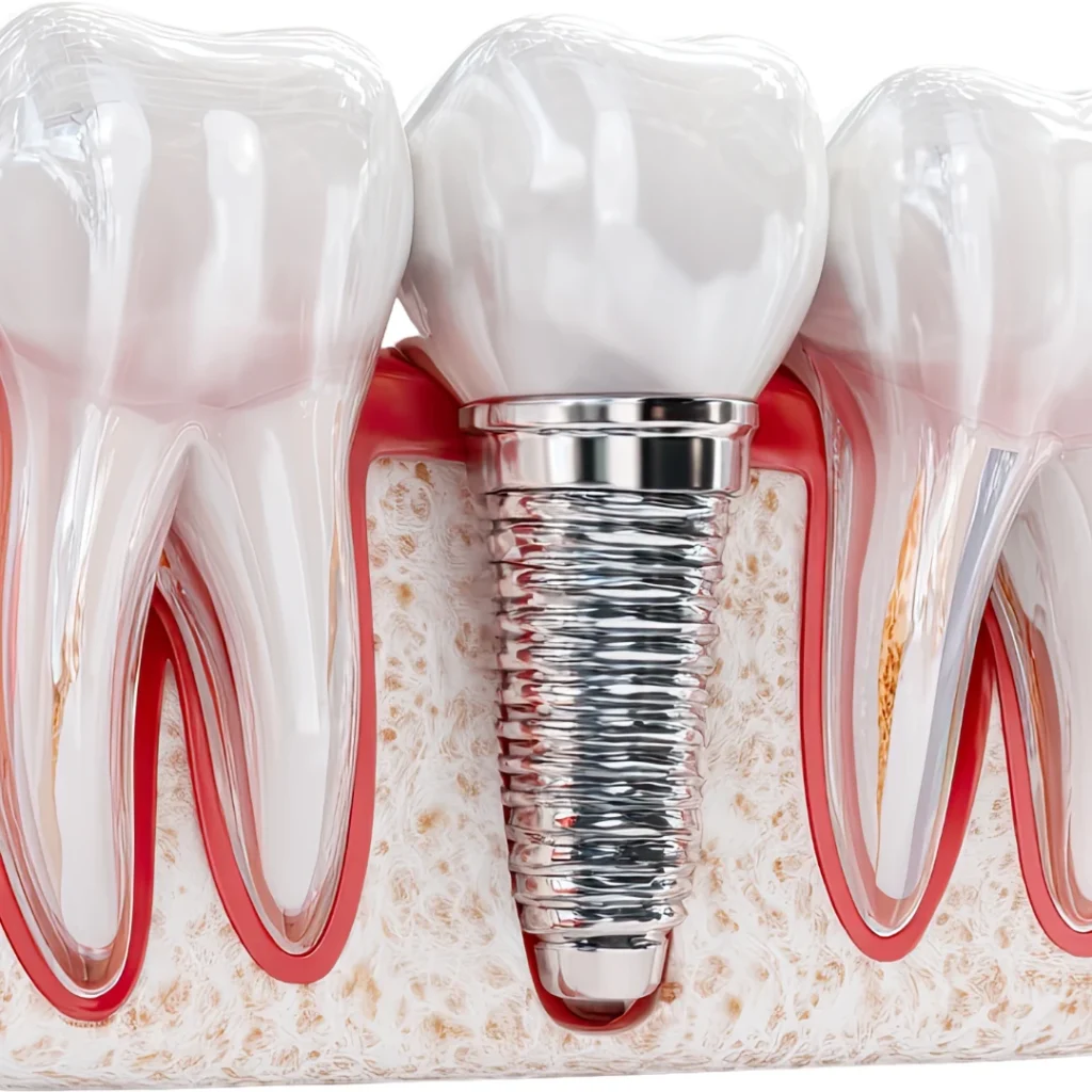 dental implants in rancho san diego